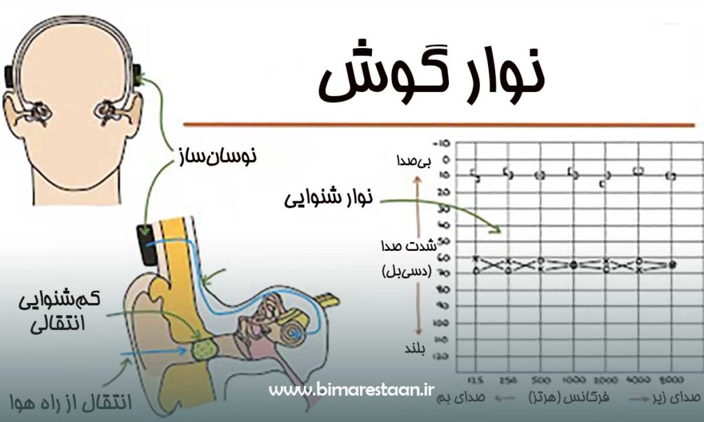 نوارگوش چیست؟
