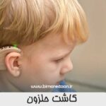 کاشت حلزون (ایمپلنت حلزون گوش)