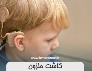 کاشت حلزون (ایمپلنت حلزون گوش)