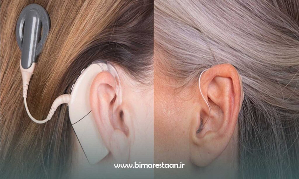 تفاوت کاشت حلزون با سمعک