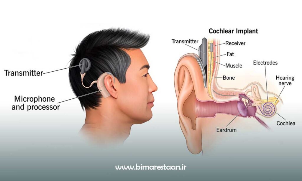 عمل کاشت حلزون گوش