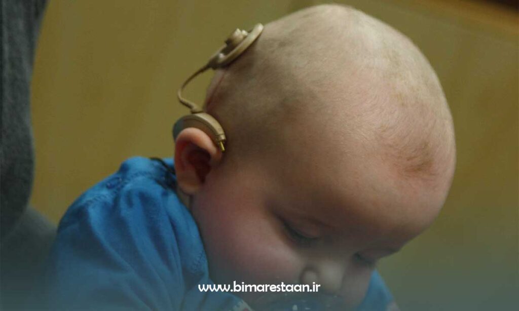 کاشت حلزون در کودکان